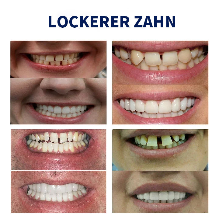 SmileFitPro™- Neue Generation Flexible Vollprothesen-Lösung