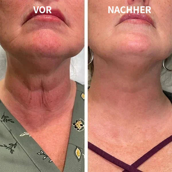 Aktion am letzten Tag: 70% RABATT â đ„ Clostridium botulinum-Gesichtsserum