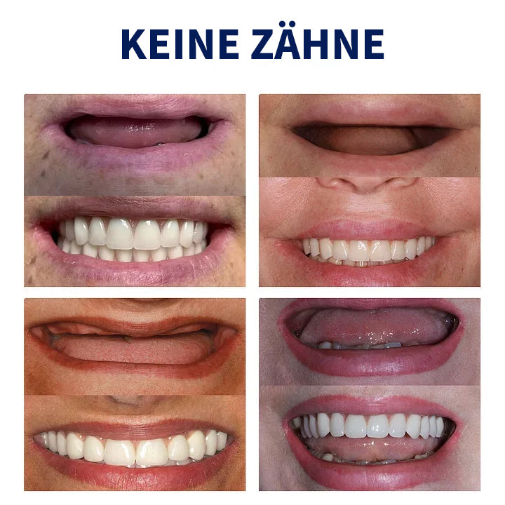 SmileFitPro™- Neue Generation Flexible Vollprothesen-Lösung