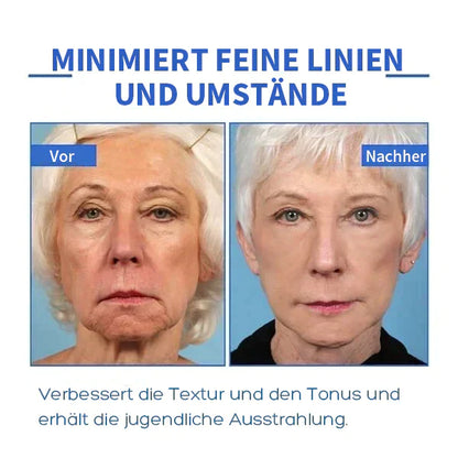 Aktion am letzten Tag: 70% RABATT – 🔥 Clostridium botulinum-Gesichtsserum